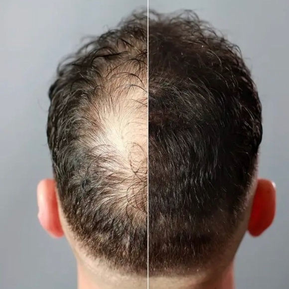 Toppik hair fiber black  3 bottle set +free 🎁conceal boldness - Picture 5 of 11